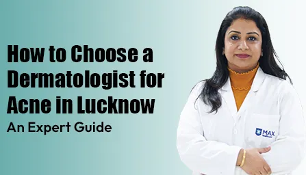 How to Choose a Dermatologist for Acne in Lucknow