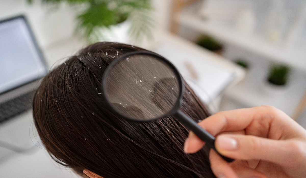 Dandruff scalp dermatology consultation in progress