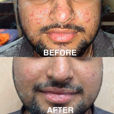 Hair loss treatment