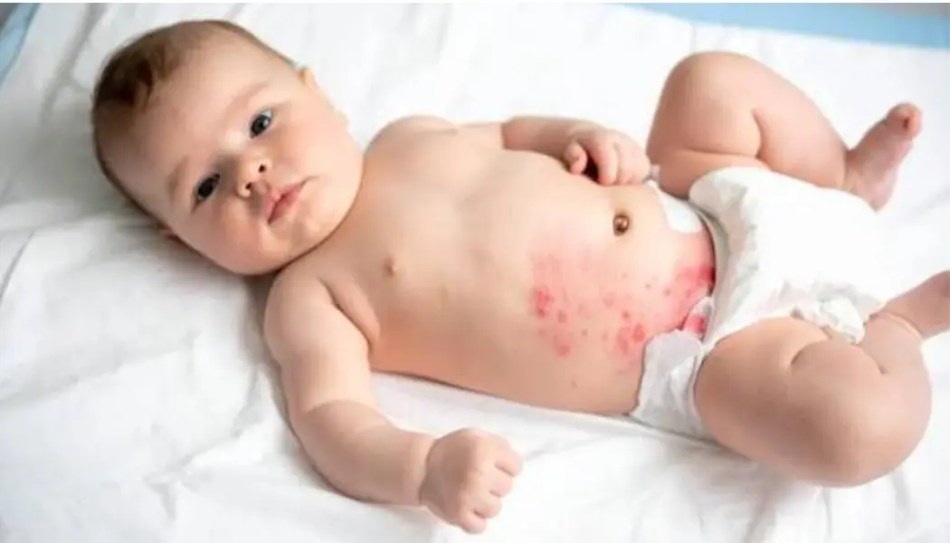 Diaper Rash