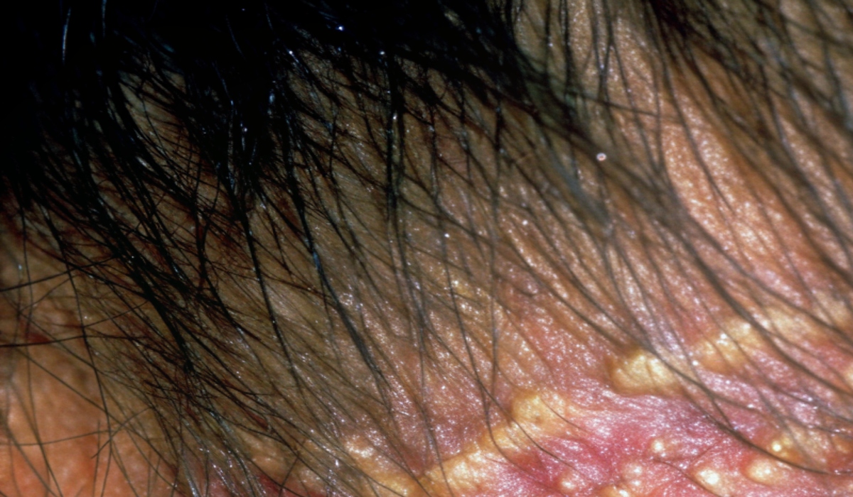 Diabetes and Kidney Failure